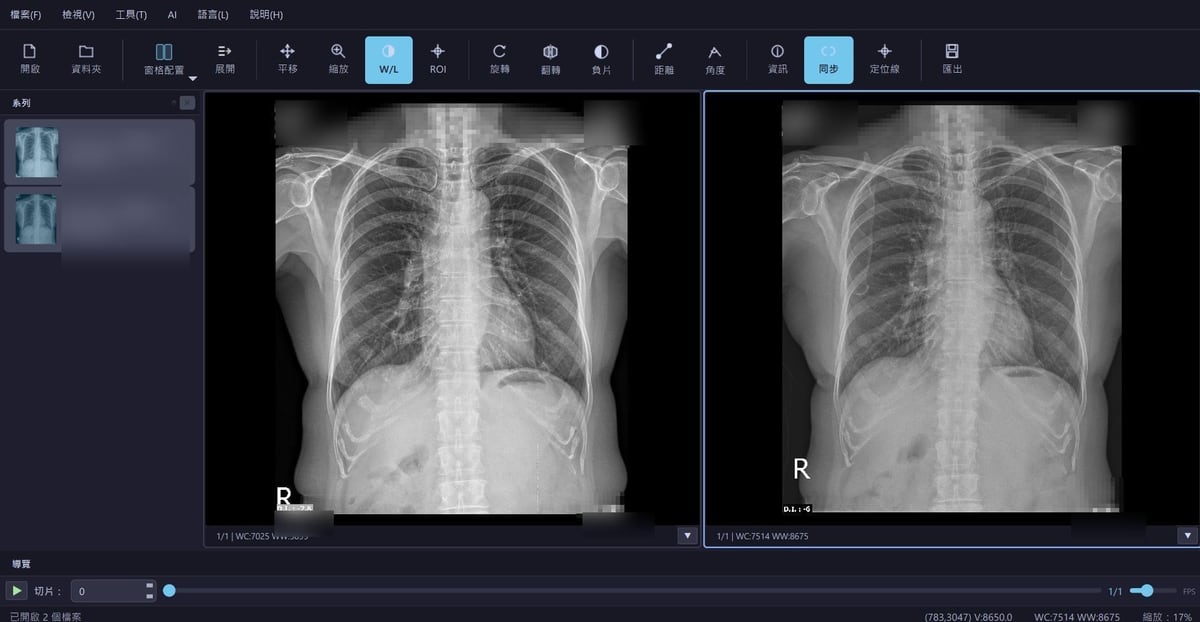 DICOM Viewer 胸部 X-ray 比較檢視畫面